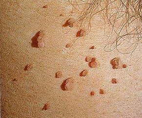 ویروس پاپیلومای انسانی روی پوست