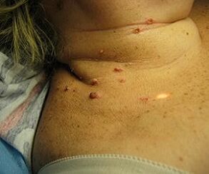 ویروس پاپیلومای انسانی روی گردن