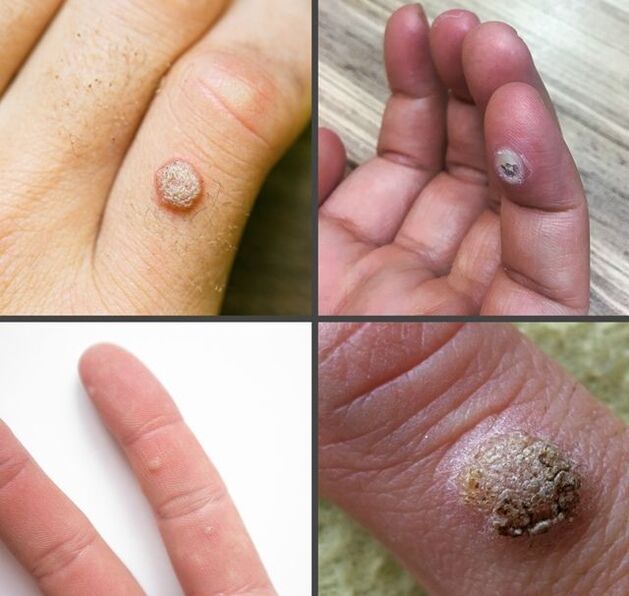 انواع رایج زگیل در انگشتان دست